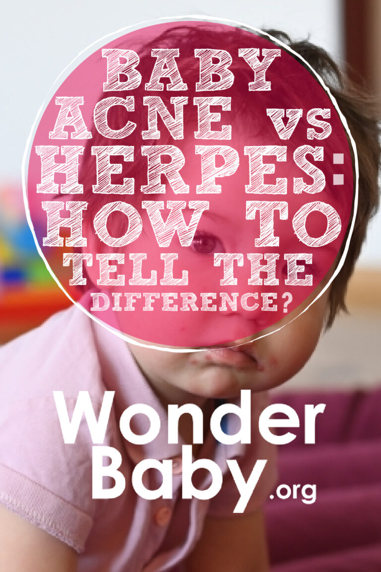 Baby Acne Vs Herpes How To Tell The Difference Wonderbaby Org