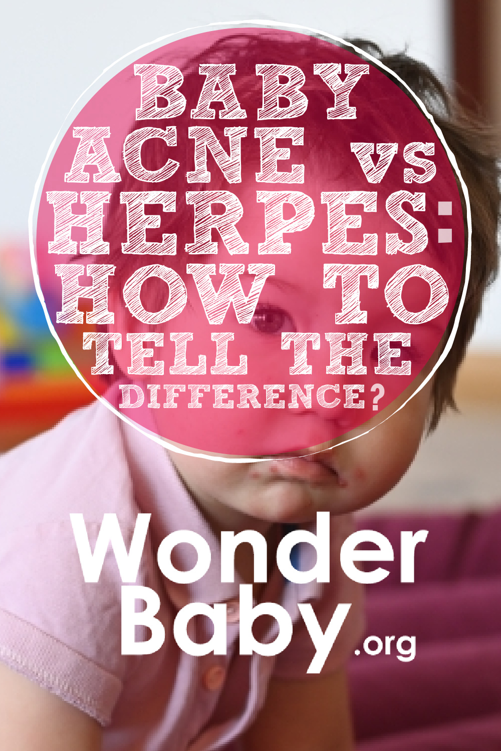 Baby Acne vs Herpes: How to Tell the Difference | WonderBaby.org