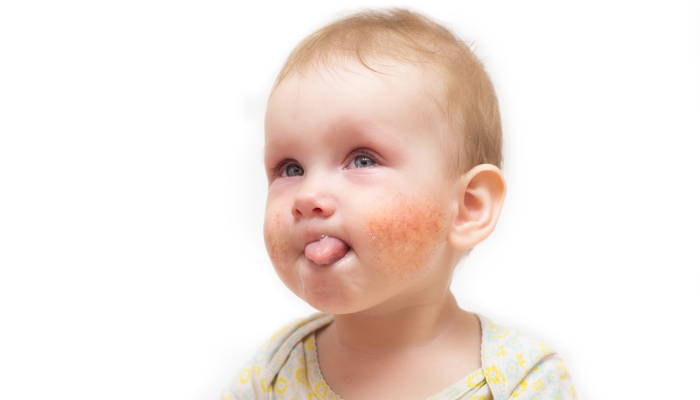 Treating Teething Rash Advice From Experts WonderBaby