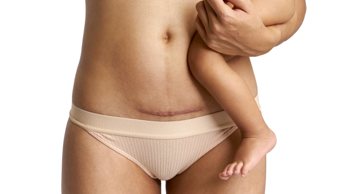Can I Ice My C-Section Incision? And Other Recovery Questions!